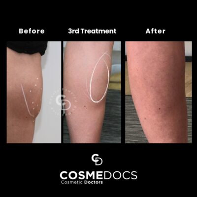 calf reduction with botox for slimmer legs