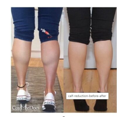 calf reduction botox before and after results