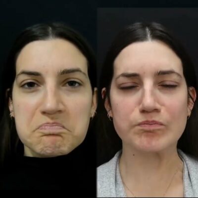Chin smoothing with Botox treatment.