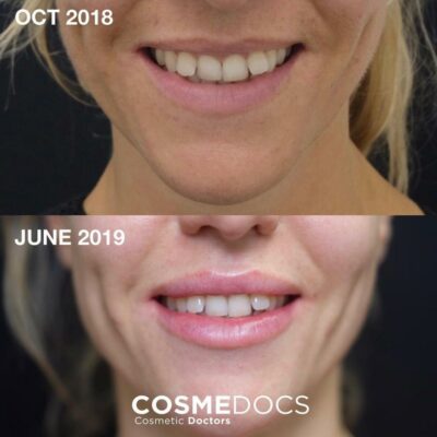 Before and after images displaying the effect of 0.5ml lip fillers per lip, highlighting enhanced fullness and a subtle reduction of a gummy smile.
