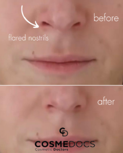 nasal flared botox before and after