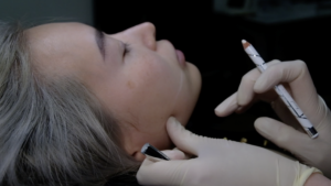 A doctor marking the masseter muscle on a patient's jawline in preparation for Botox treatment to alleviate teeth grinding.