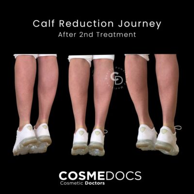 Client A: Progress after session 2 of calf reduction Botox, showcasing enhanced slimming.