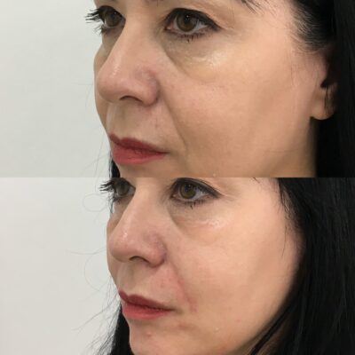 Image of smile line filler before and after