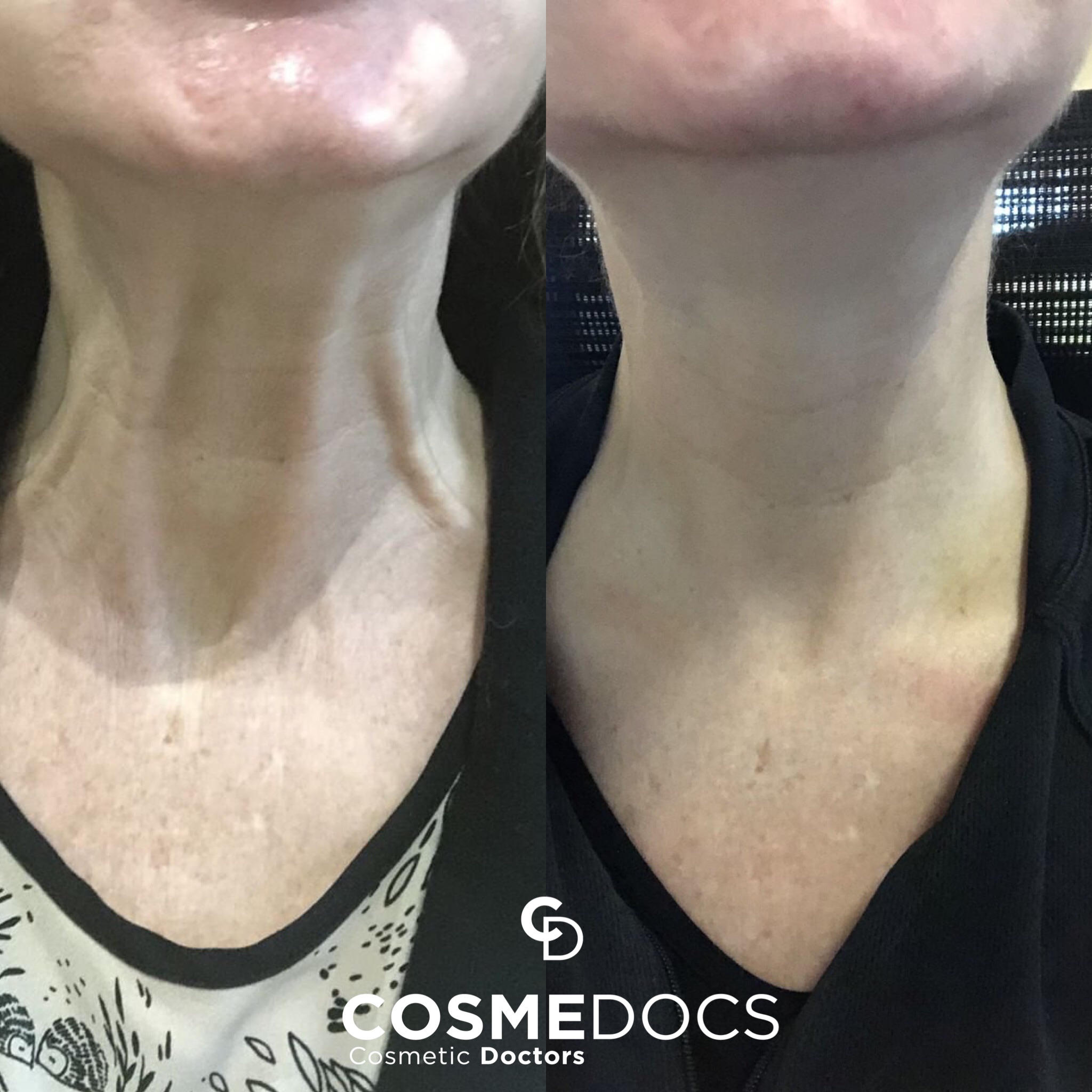 Before and after photos showing the effects of Botox in the neck, illustrating a noticeable Nefertiti Neck Lift with smoother, tighter neck skin.