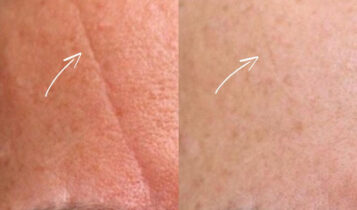 an image showing dermal fillers before and after for forehead line