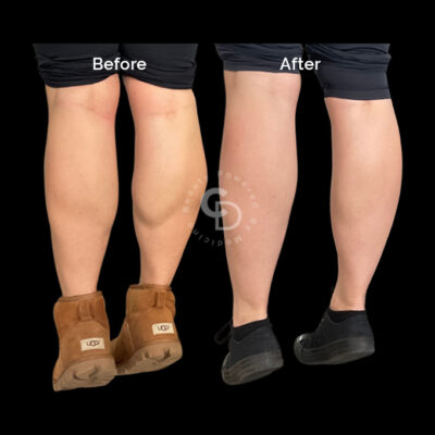 Before and after photos of calf reduction Botox treatment showing reduced calf size.
