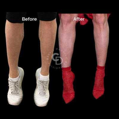 Client A: Progress shown after the first session of Botox calf reduction.