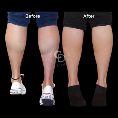 Before and after images demonstrating calf size reduction following Botox treatment.